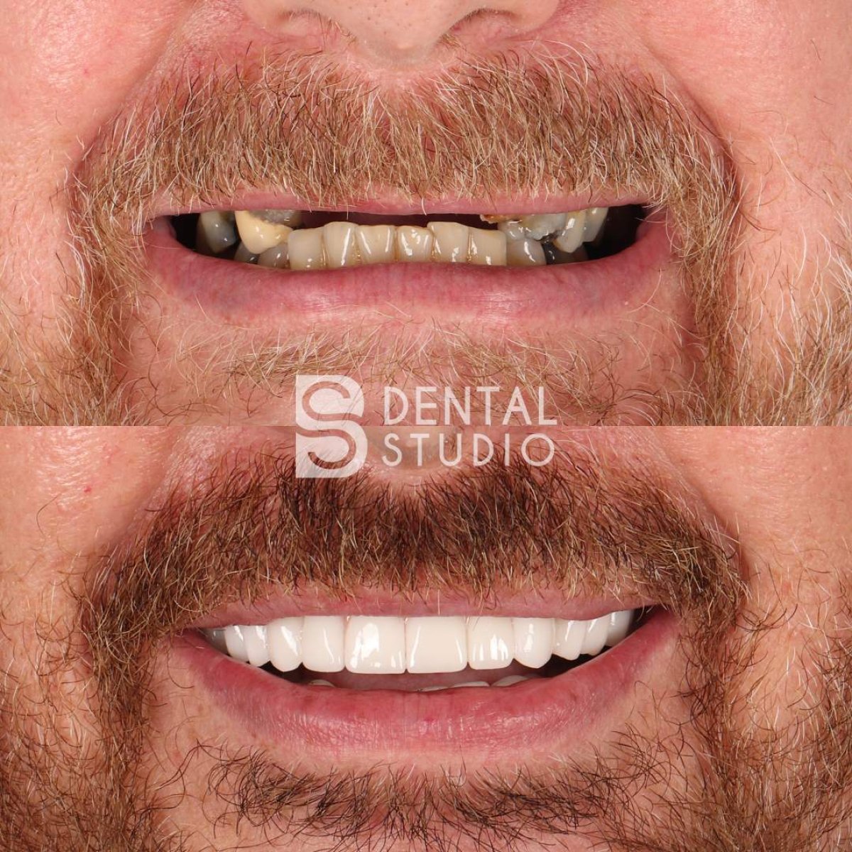 До и после установки виниров в BS Dental Studio, преображение улыбки с естественным результатом