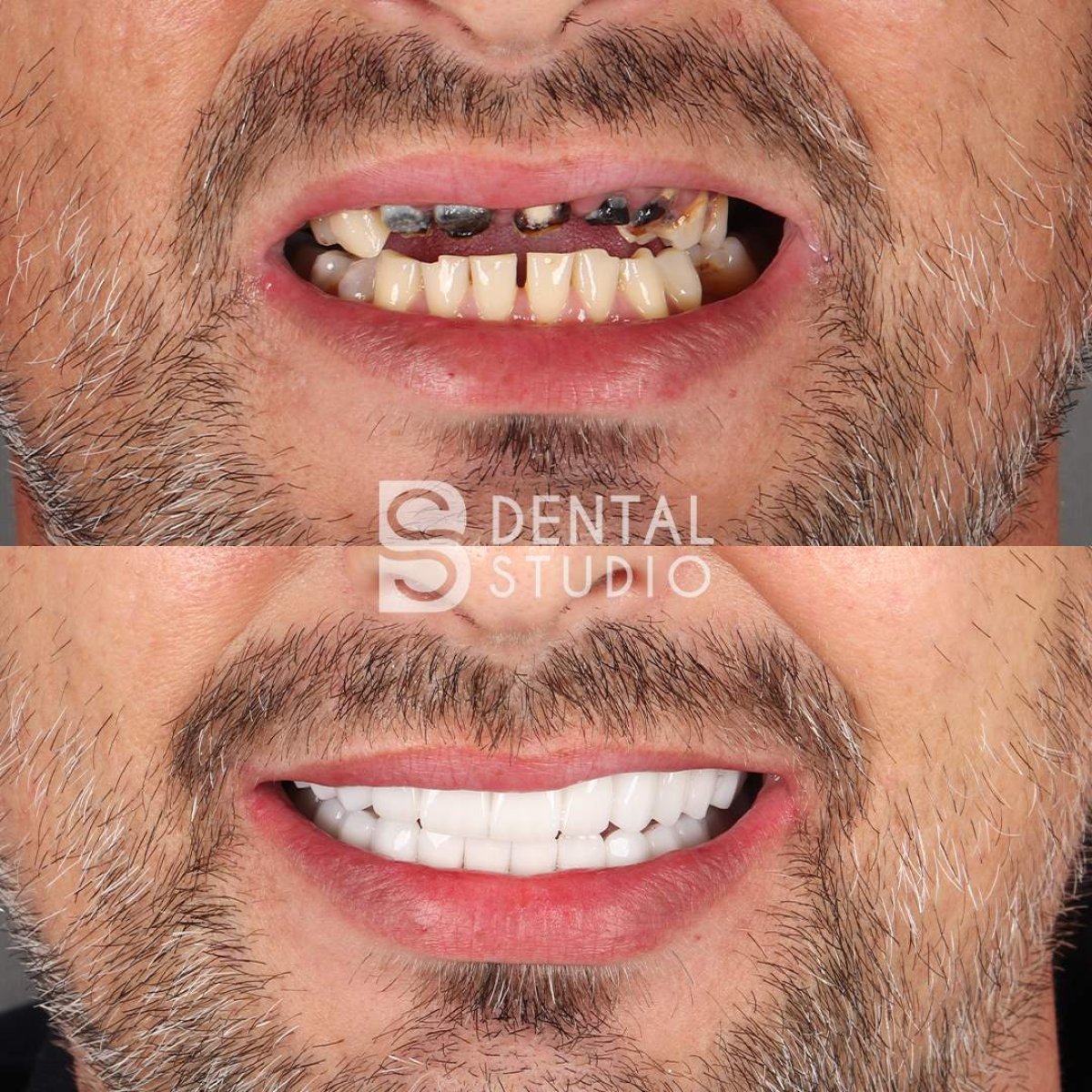 До та після встановлення вінірів у BS Dental Studio – перетворення посмішки з природним результатом