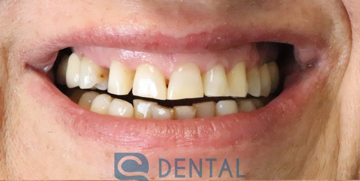До встановлення вінірів у BS Dental Studio – видно потемніння та нерівність зубів