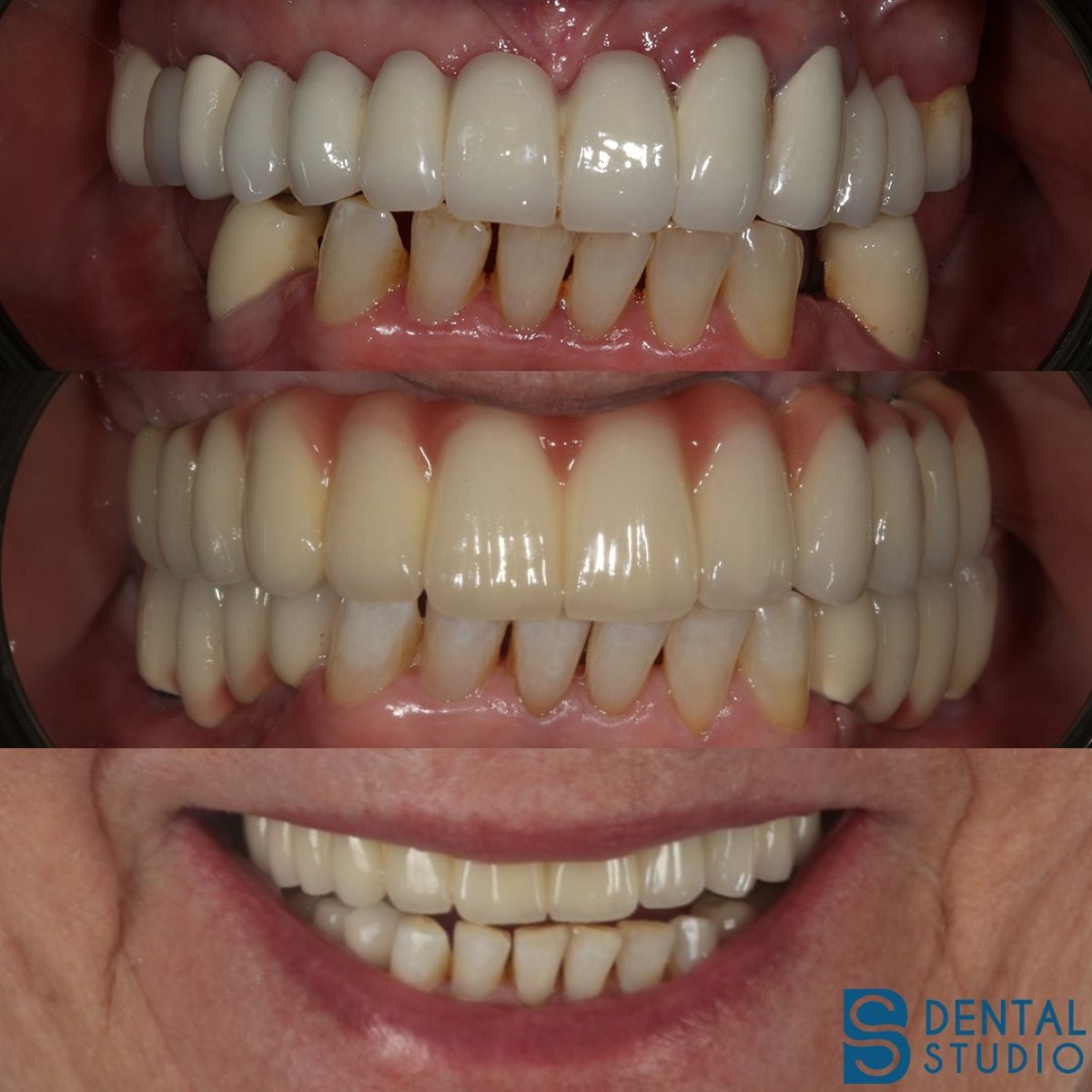 Résultats avant/après couronnes zircone chez BS Dental Studio – sourire amélioré