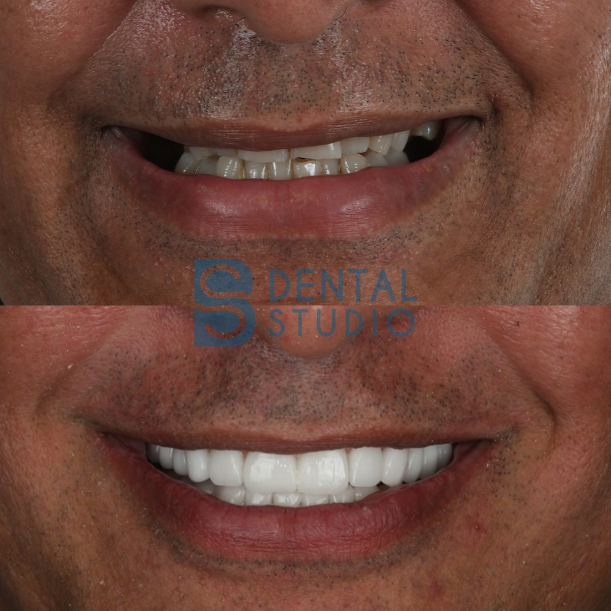 До и после установки циркониевых коронок в BS Dental Studio – результат улыбки
