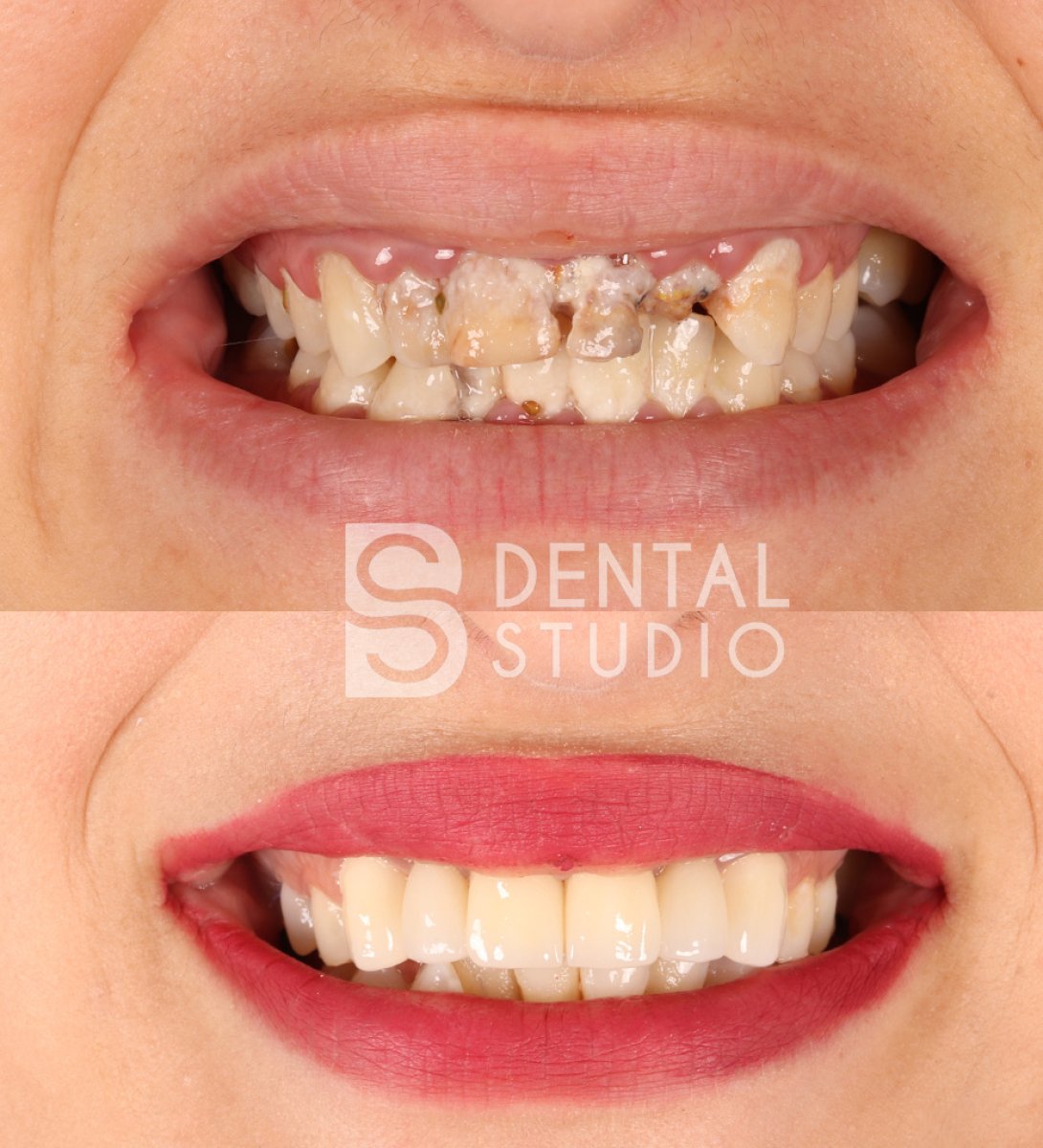 Before and after zirconia crown installation at BS Dental Studio – smile restoration result