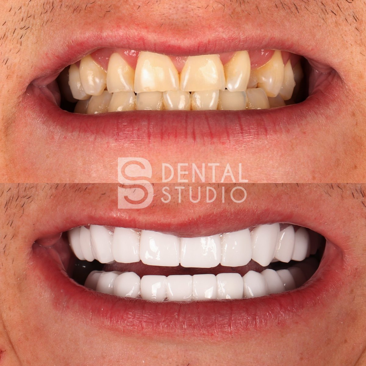 Before and after zirconia crown results at BS Dental Studio – smile makeover and whiter teeth