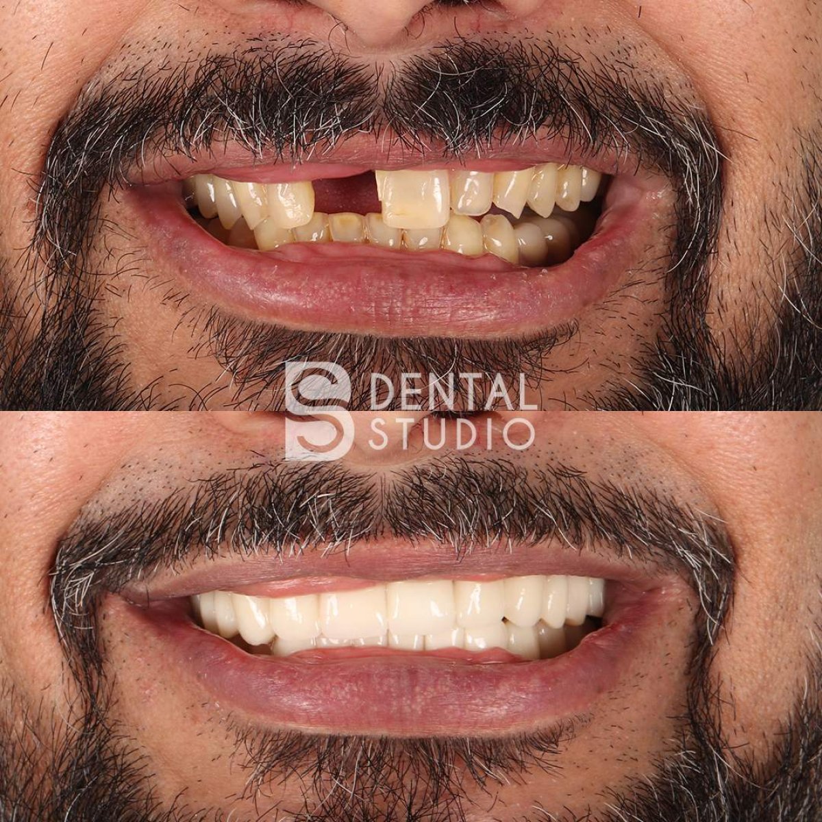 قبل وبعد تركيب الأطراف السنية في BS Dental Studio، نتيجة استعادة الابتسامة