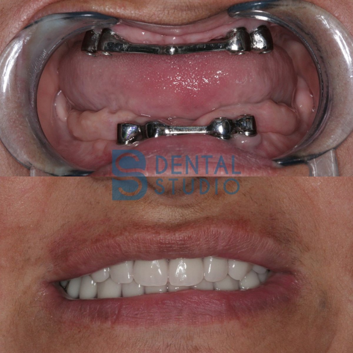 نتائج قبل وبعد تركيب الأطراف السنية في BS Dental Studio، ابتسامة محسنة