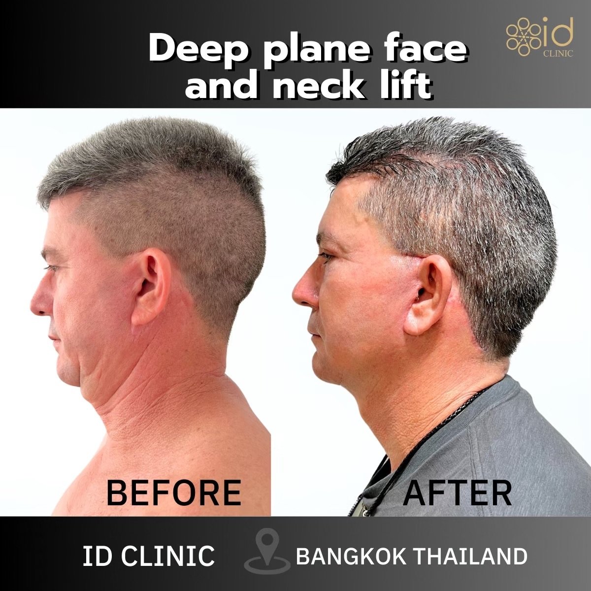 Before and after deep plane face and neck lift results at ID Clinic Bangkok, visible tightening