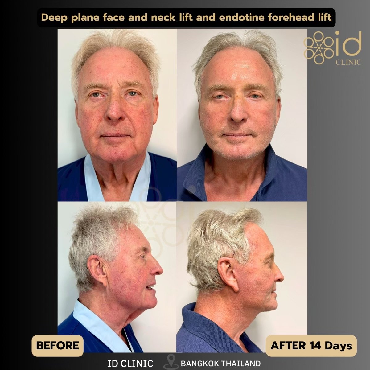 Before and after deep plane facelift and neck lift results at ID Clinic Bangkok, 14 days post-op
