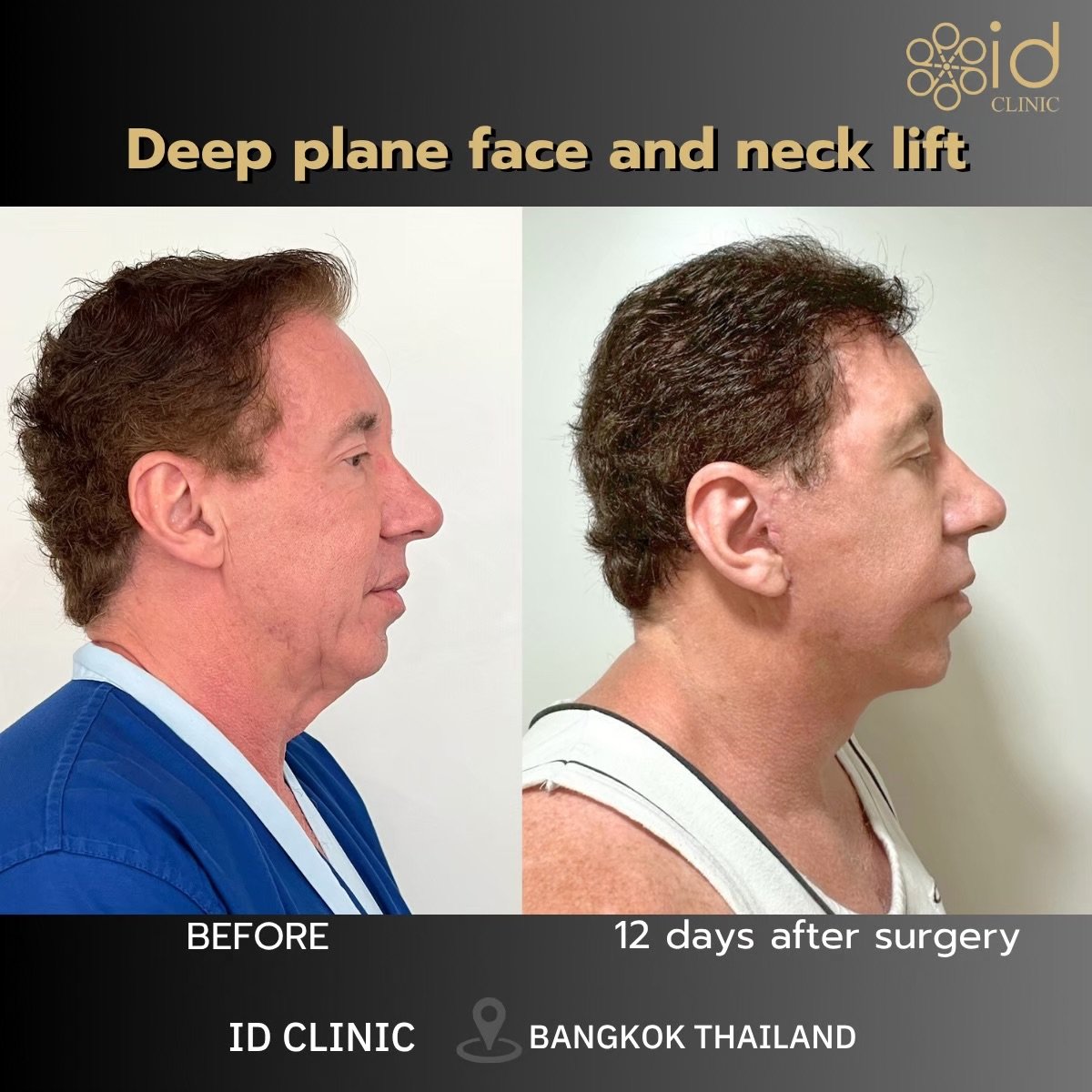 Before and after deep plane face and neck lift results at ID Clinic Bangkok, visible lift effect
