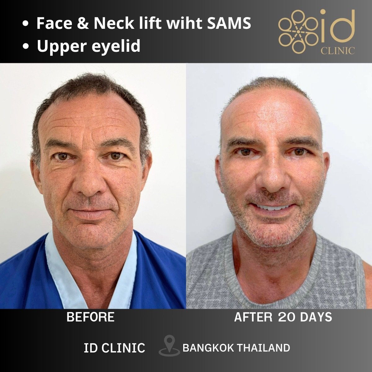 Before and after mini facelift and upper eyelid surgery results at ID Clinic Bangkok