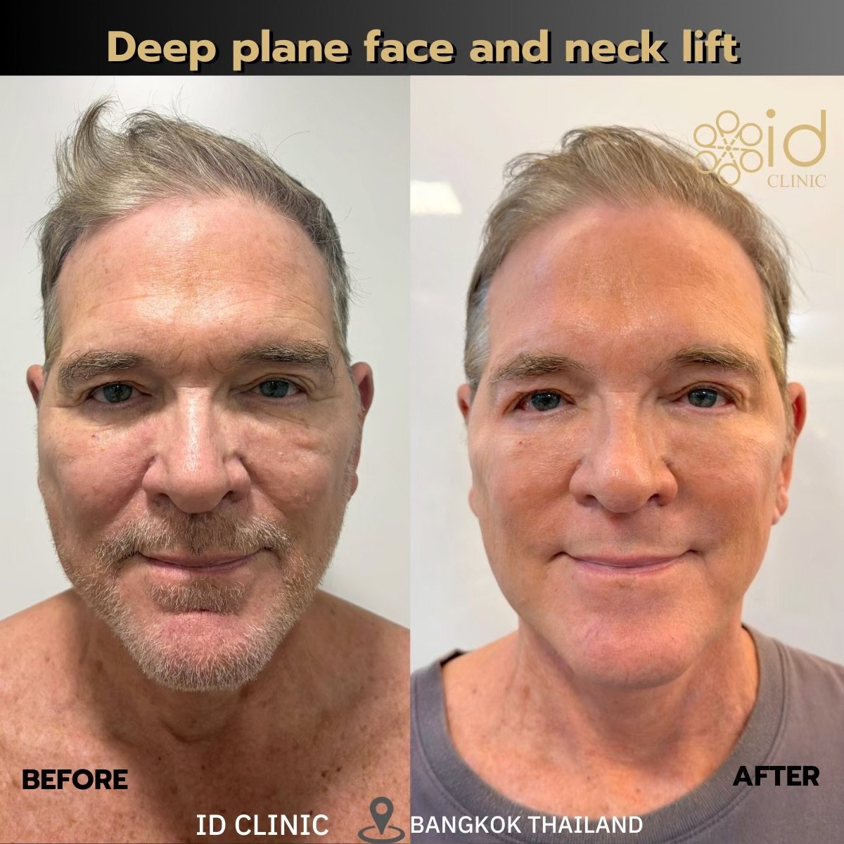 Before and after deep plane face and neck lift results at ID Clinic Bangkok, rejuvenated look