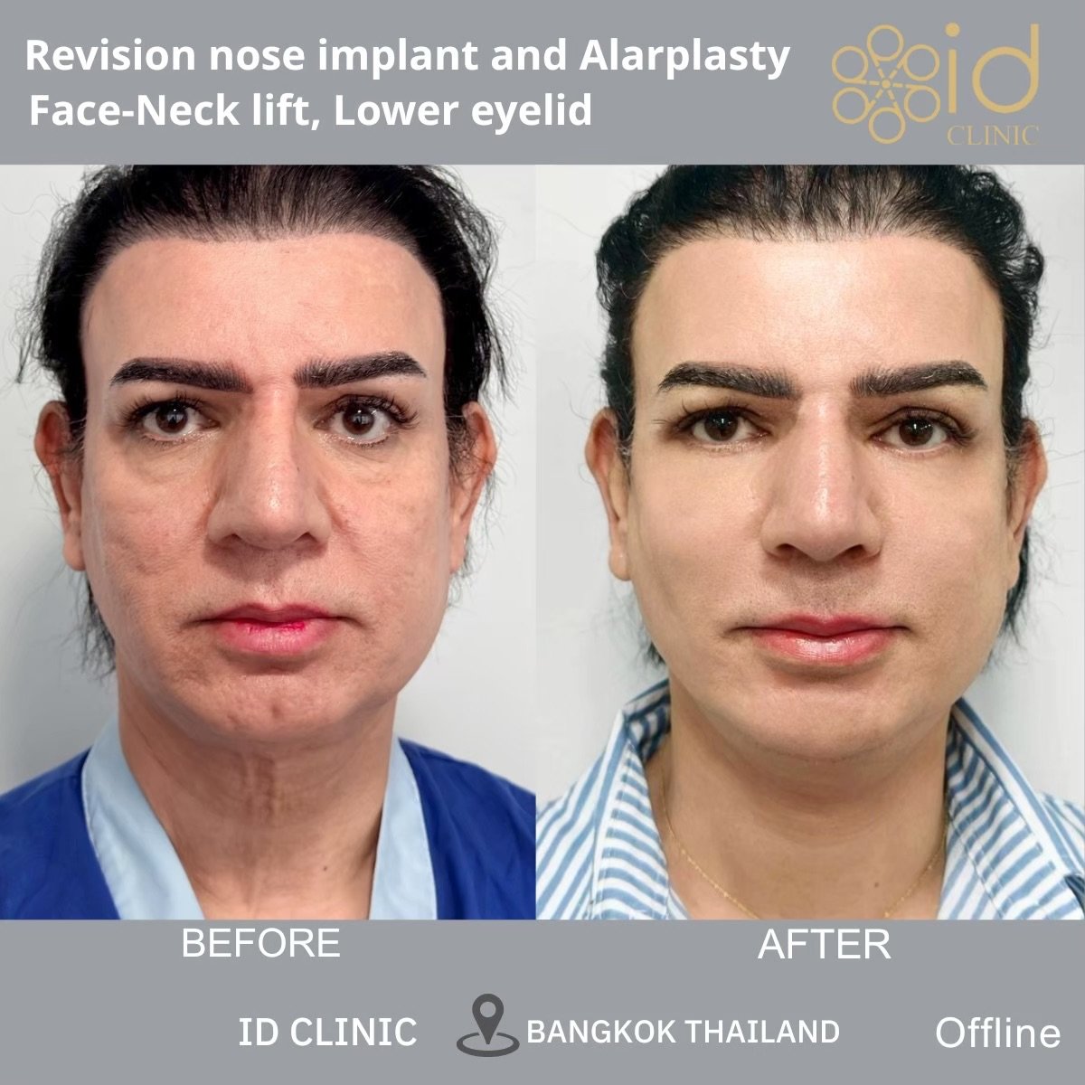 Before and after face-neck lift, nose revision, alarplasty at ID Clinic Bangkok, visible results