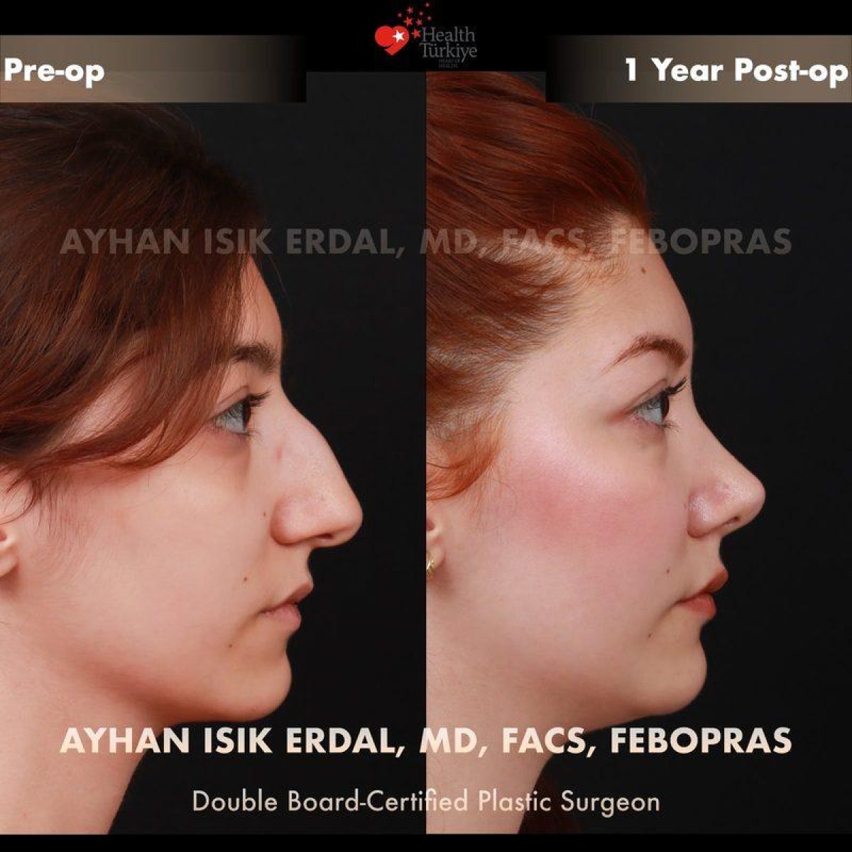 Efekty przed i po rhinoplastyce w Ayhan Işık Erdal, MD, FACS, FEBOPRAS