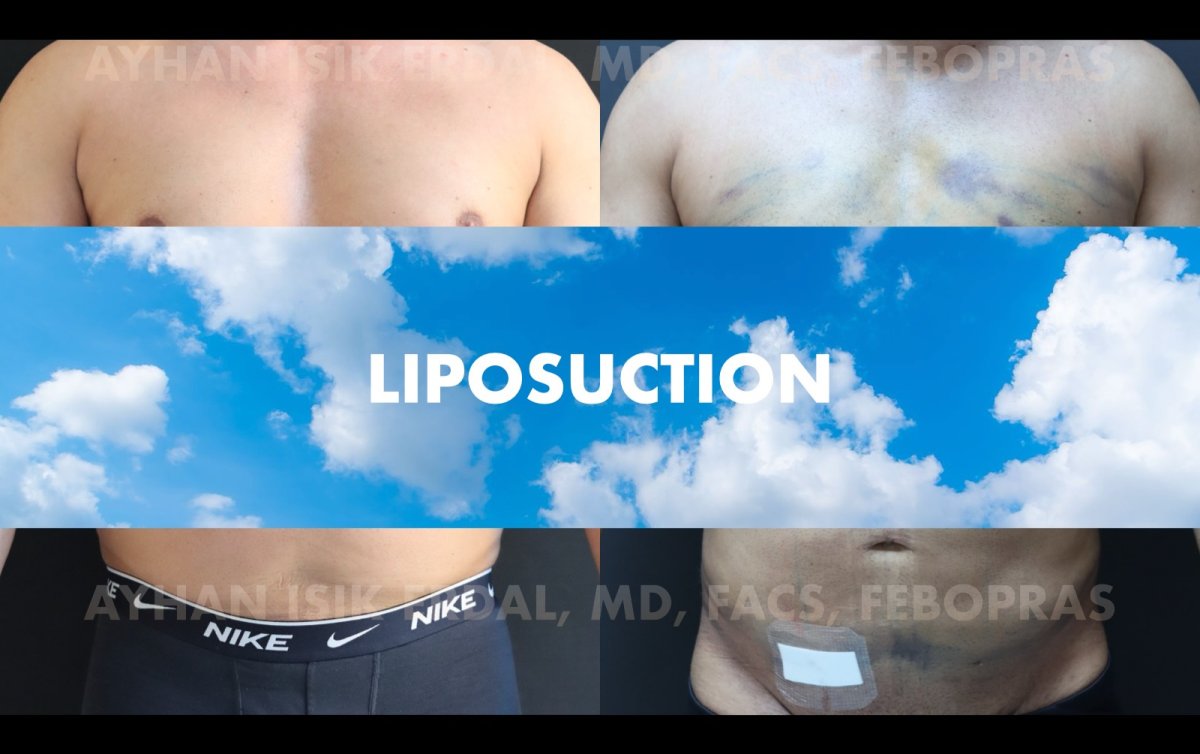 Before and after liposuction results at Ayhan Işık Erdal, MD, FACS, FEBOPRAS clinic