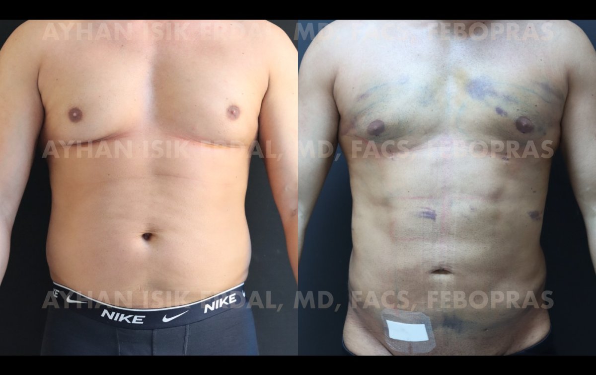 Результаты до и после 360 липосакции в клинике Ayhan Işık Erdal, MD, FACS, FEBOPRAS