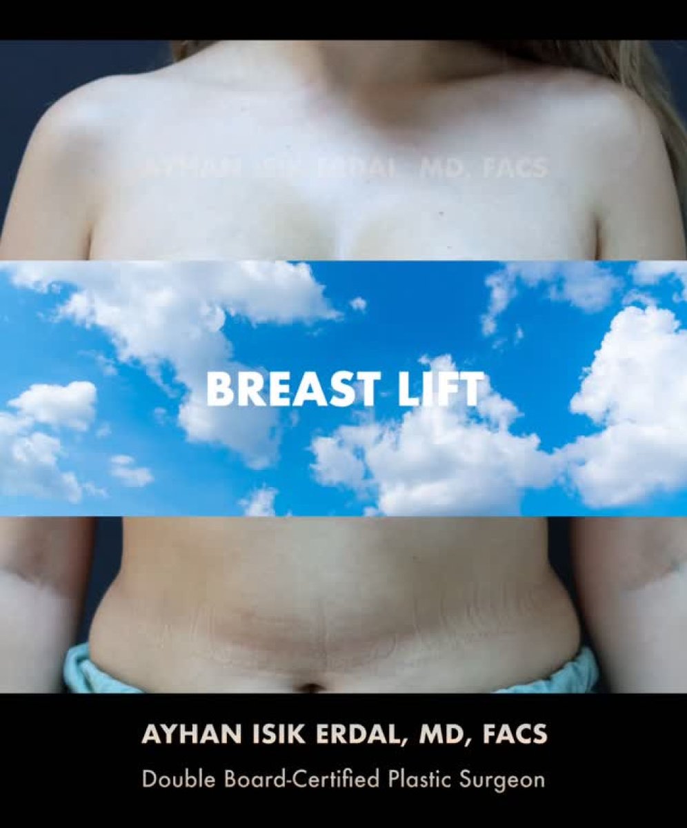 Breast lift result at Ayhan Işık Erdal, MD, FACS, FEBOPRAS – visible breast contour improvement