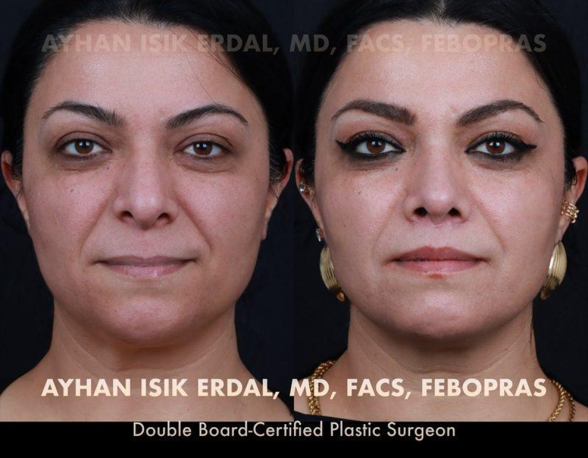 Vorher-nachher-Ergebnis Lip Lift bei Ayhan Işık Erdal, MD, FACS, FEBOPRAS – verbesserte Lippenkontur