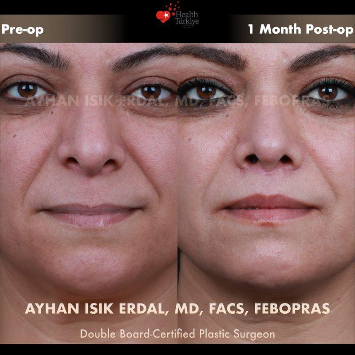 Vorher-nachher-Ergebnis Lip Lift bei Ayhan Işık Erdal, MD, FACS, FEBOPRAS, verbesserte Lippenkontur