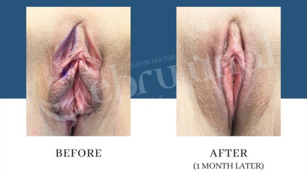 Before and after non-surgical labiaplasty results at Dr. Ebru Unal Cosmetic Gynecology Clinic