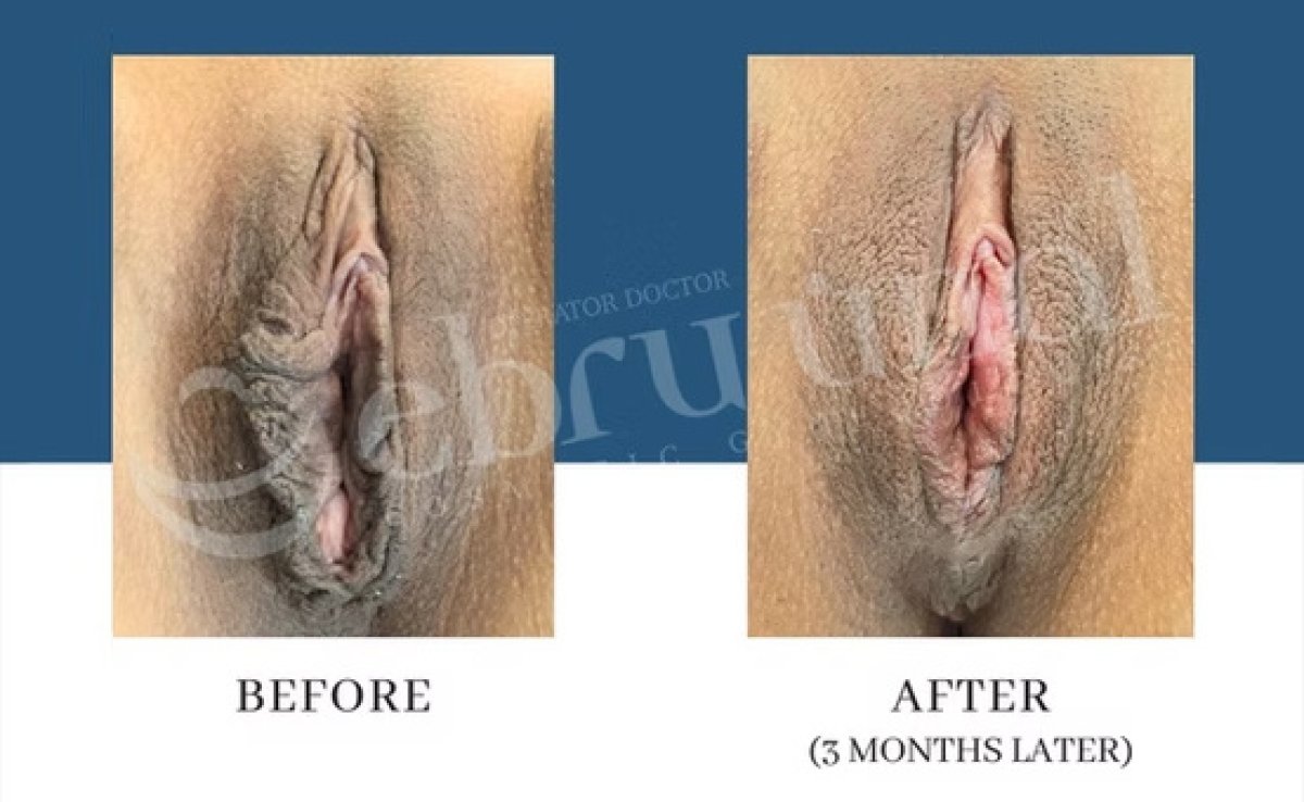Before and after non-surgical labiaplasty results at Dr. Ebru Unal Cosmetic Gynecology Clinic