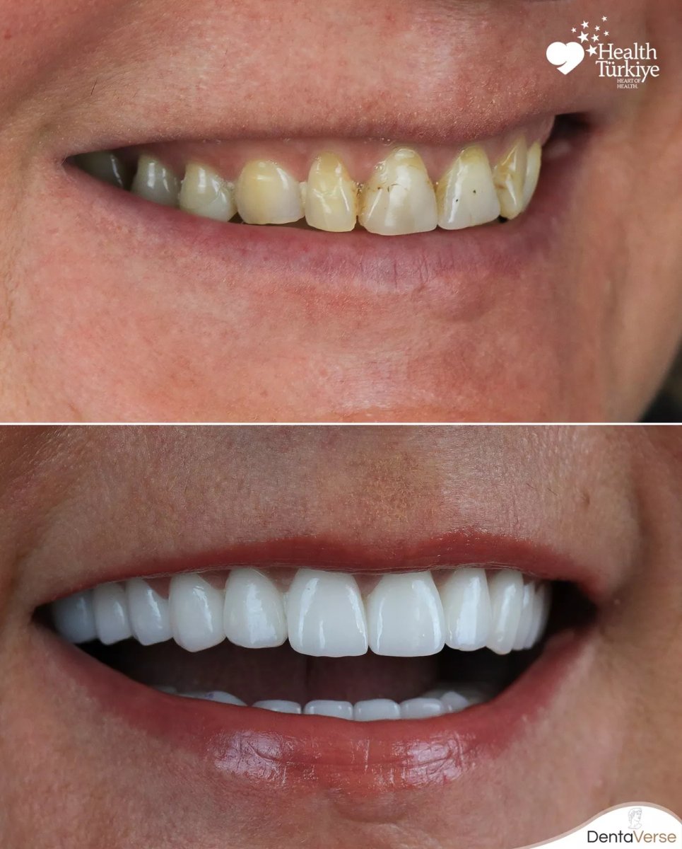 Resultados antes y después de Hollywood Smile en Dentaverse Turkey – transformación con carillas