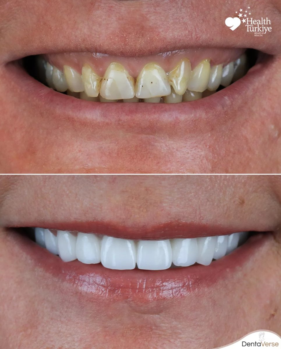 Hollywood Smile before and after results at Dentaverse Turkey – dental veneers transformation