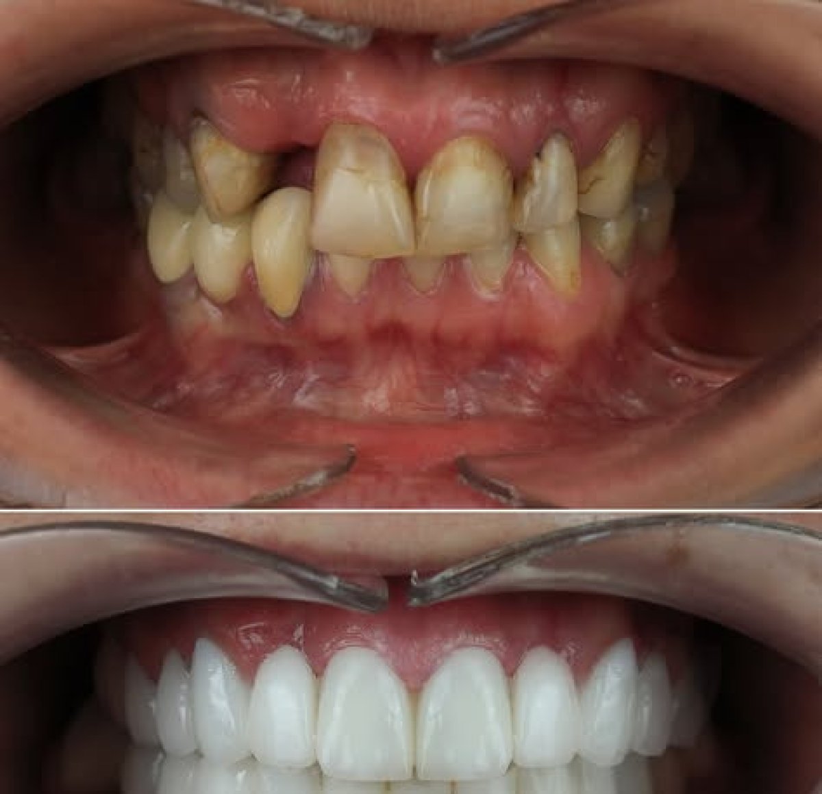 Hollywood Smile before and after results at Dentaverse Turkey – dental veneers smile makeover