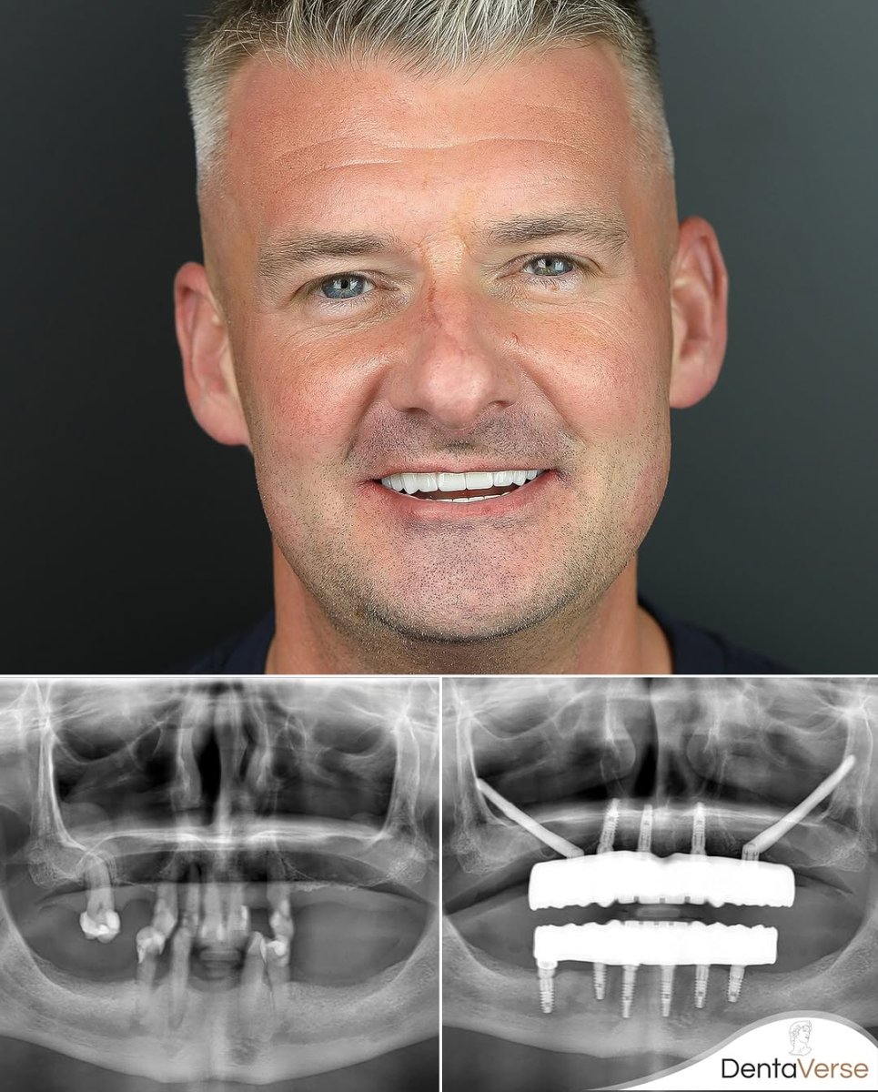 Zygomatic implant before and after results at Dentaverse Turkey – improved smile and jaw structure
