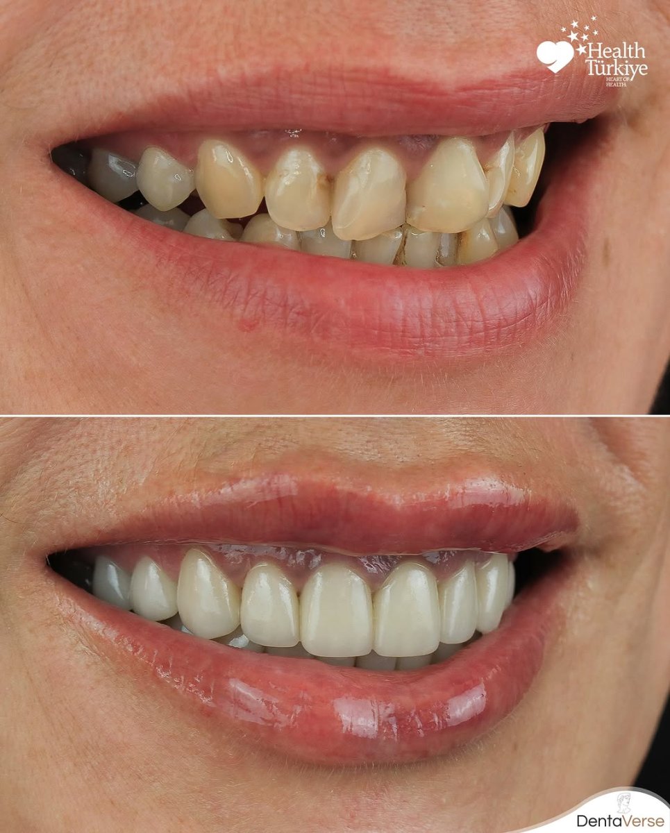 Antes y después de carillas dentales en Dentaverse Turkey – sonrisa natural tras el cambio