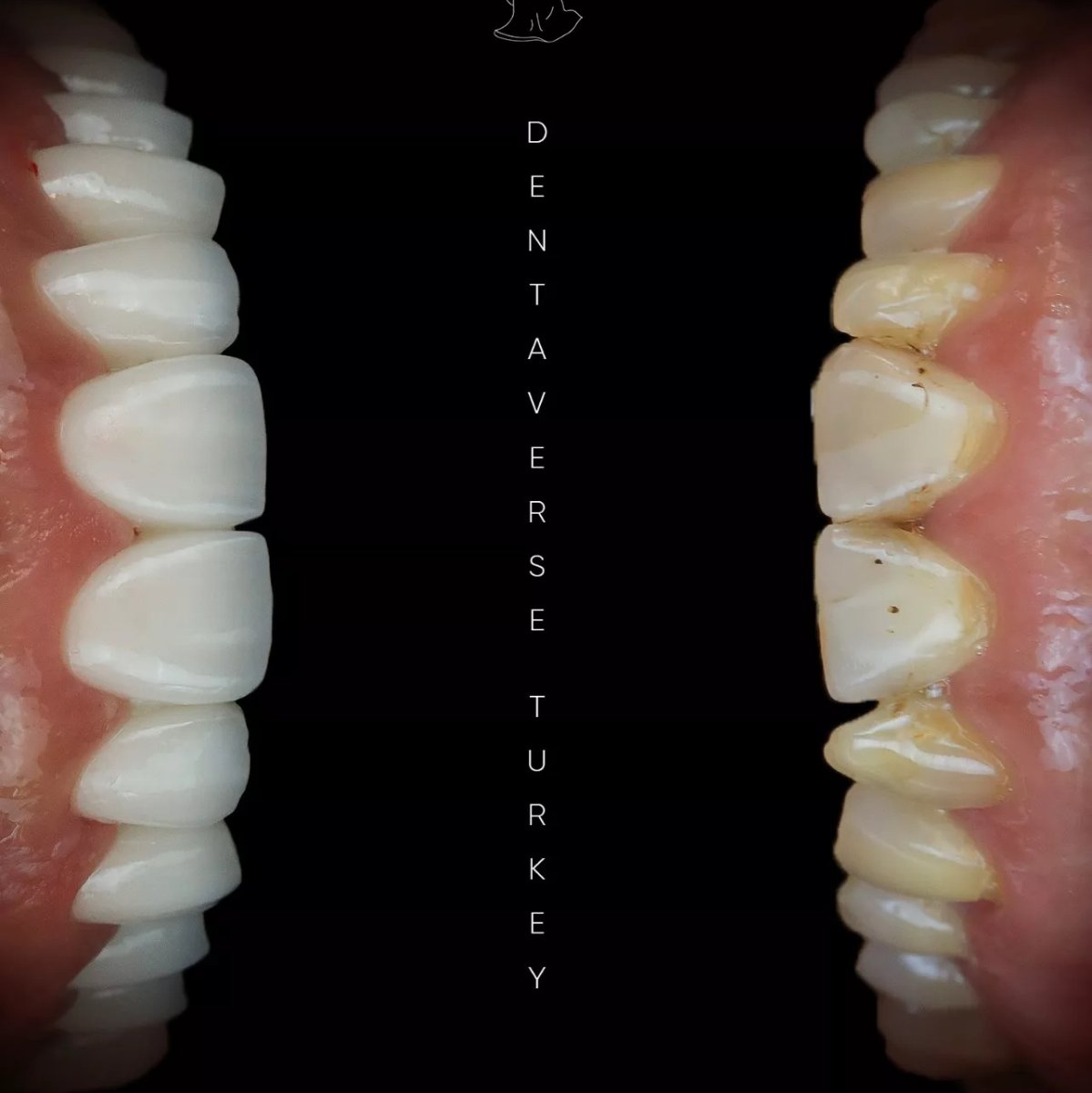 Before and after tooth whitening results at Dentaverse Turkey, visibly brighter teeth