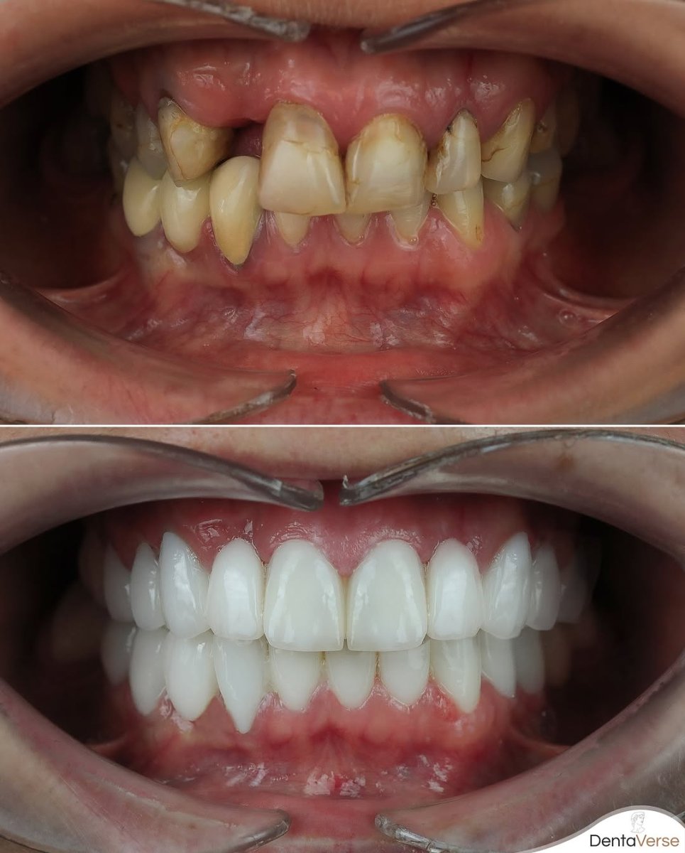 Smile makeover before and after results at Dentaverse Turkey – dental veneers transformation