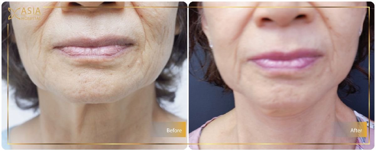 Before and after neck lift results at Asia Cosmetic Hospital – visible skin tightening effect