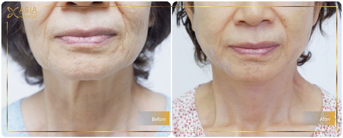 Before and after neck lift results at Asia Cosmetic Hospital – visible skin tightening effect