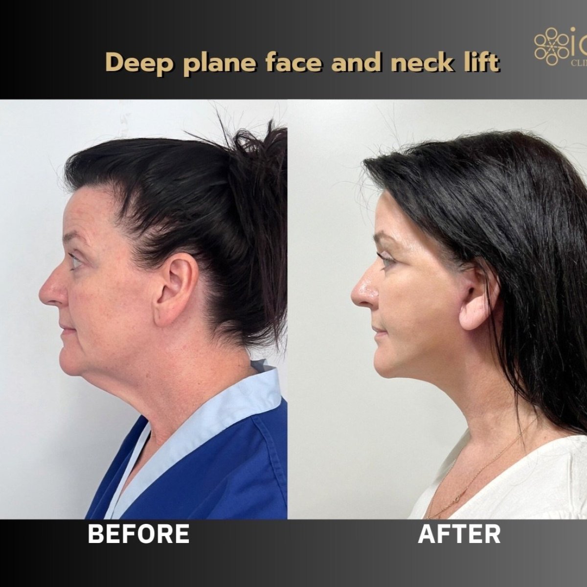 Before and after deep plane face and neck lift results at ID Clinic Bangkok, visible rejuvenation