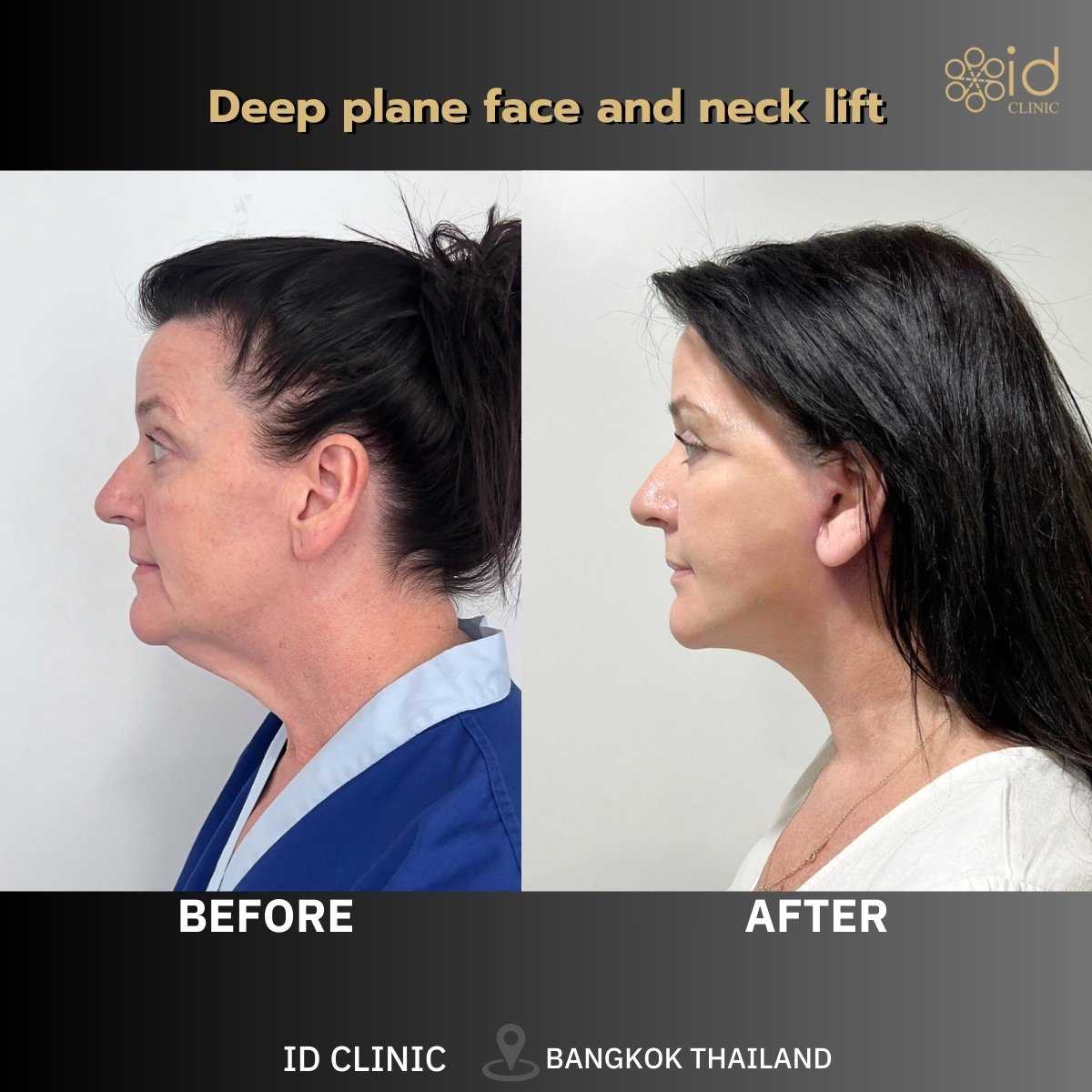 Before and after deep plane face and neck lift results at ID Clinic Bangkok, visible rejuvenation