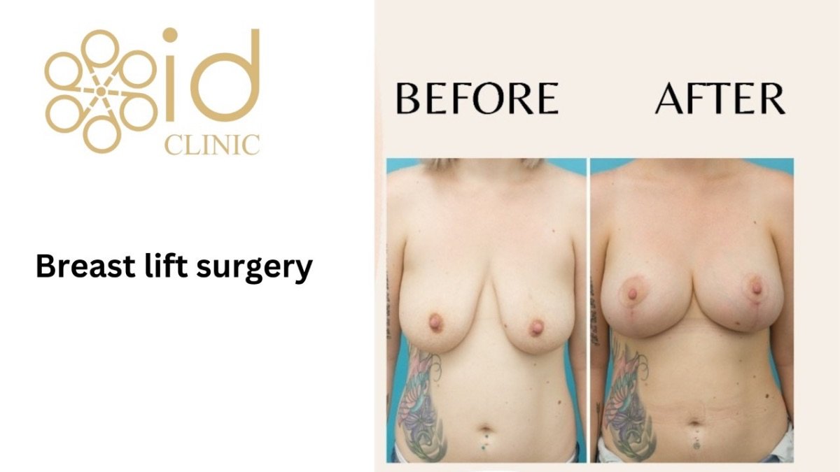Before and after breast lift surgery results at ID Clinic Bangkok, visible breast contour improvement