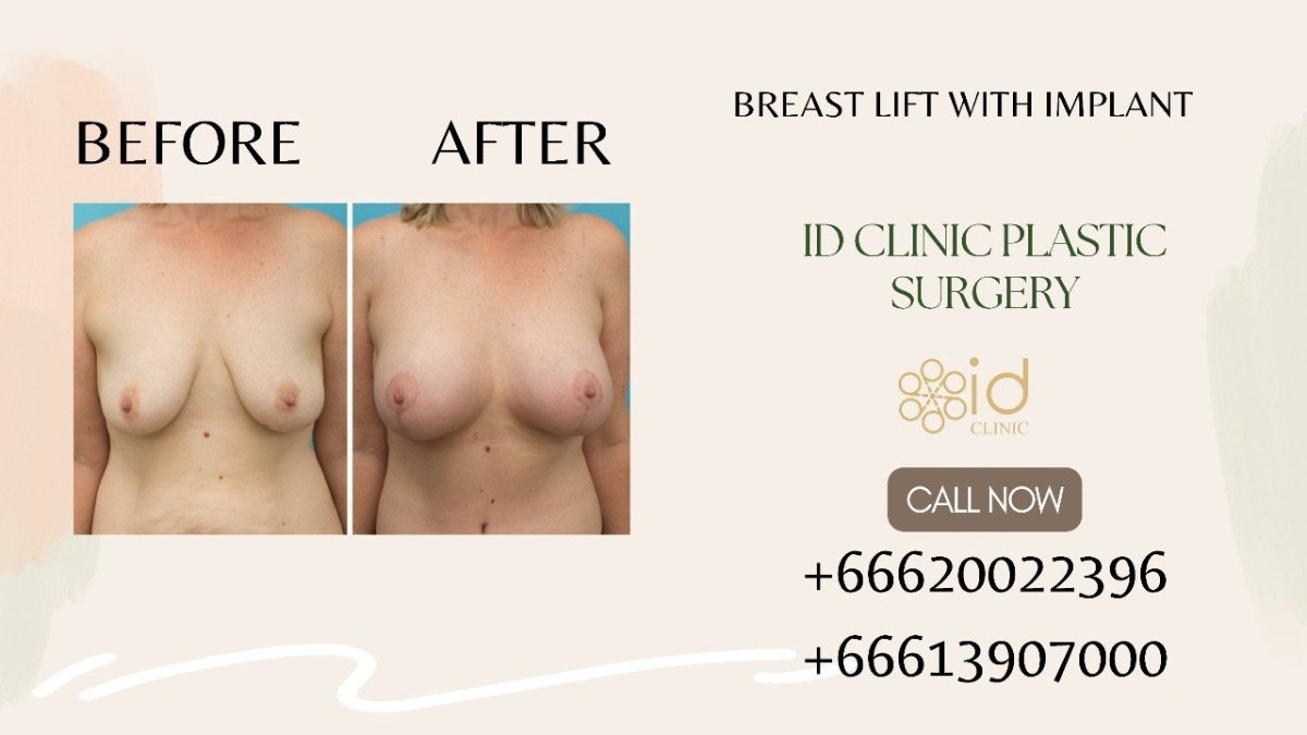 Before and after breast lift with implant results at ID Clinic Bangkok, improved breast shape