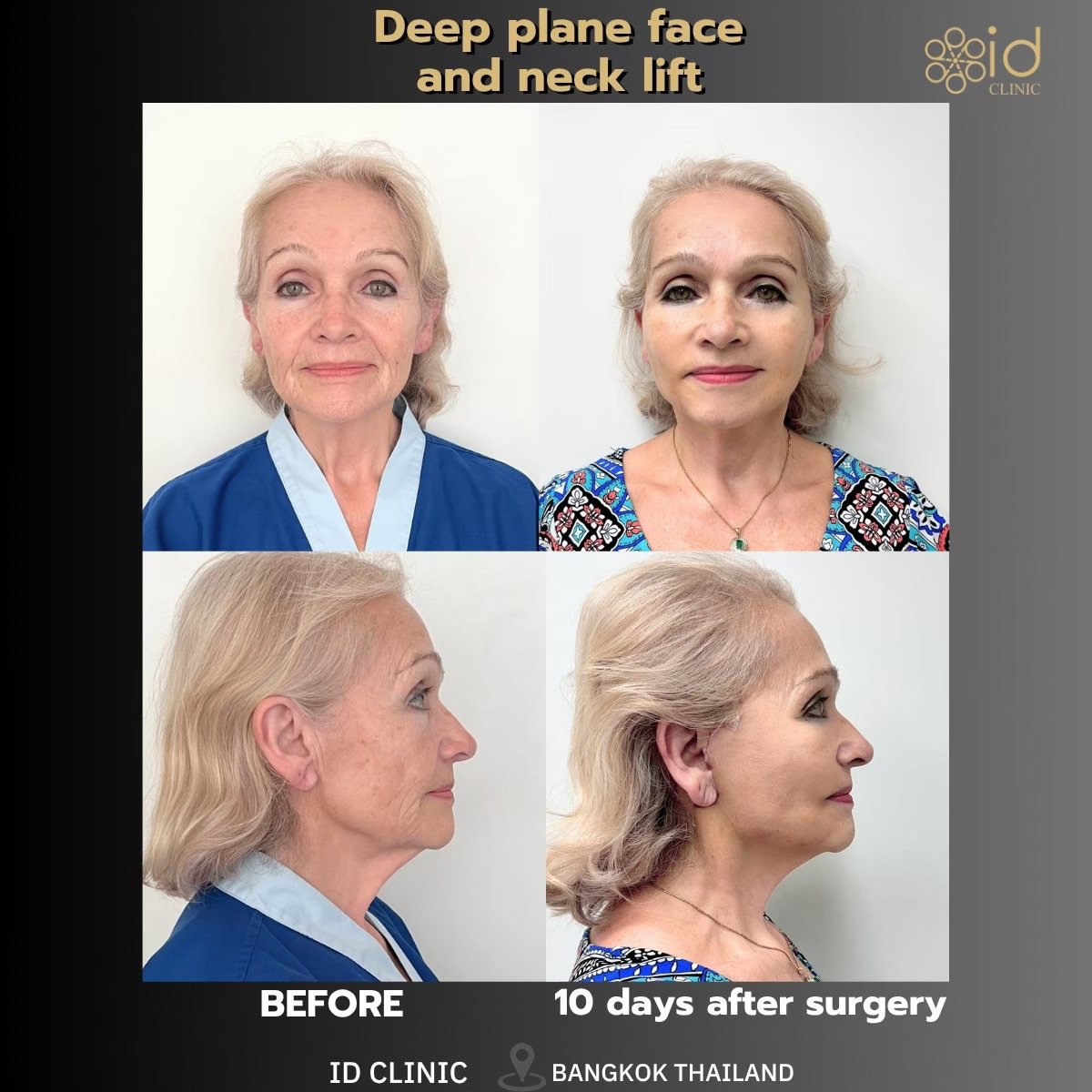 Before and after deep plane face and neck lift results at ID Clinic Bangkok, visible rejuvenation