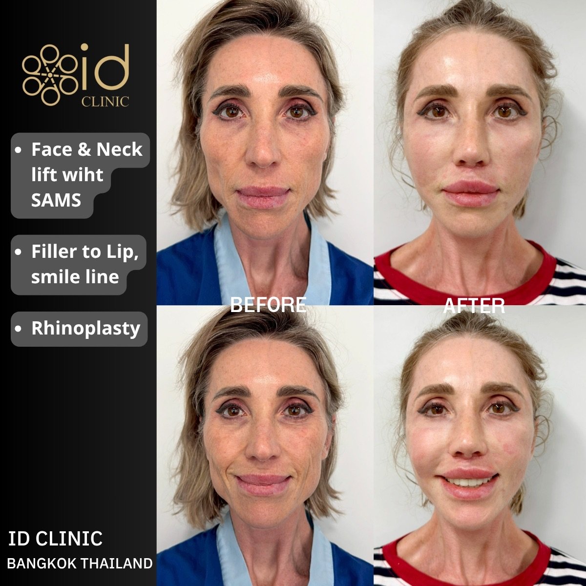 Before and after face and neck lift, lip filler, and rhinoplasty results at ID Clinic Bangkok