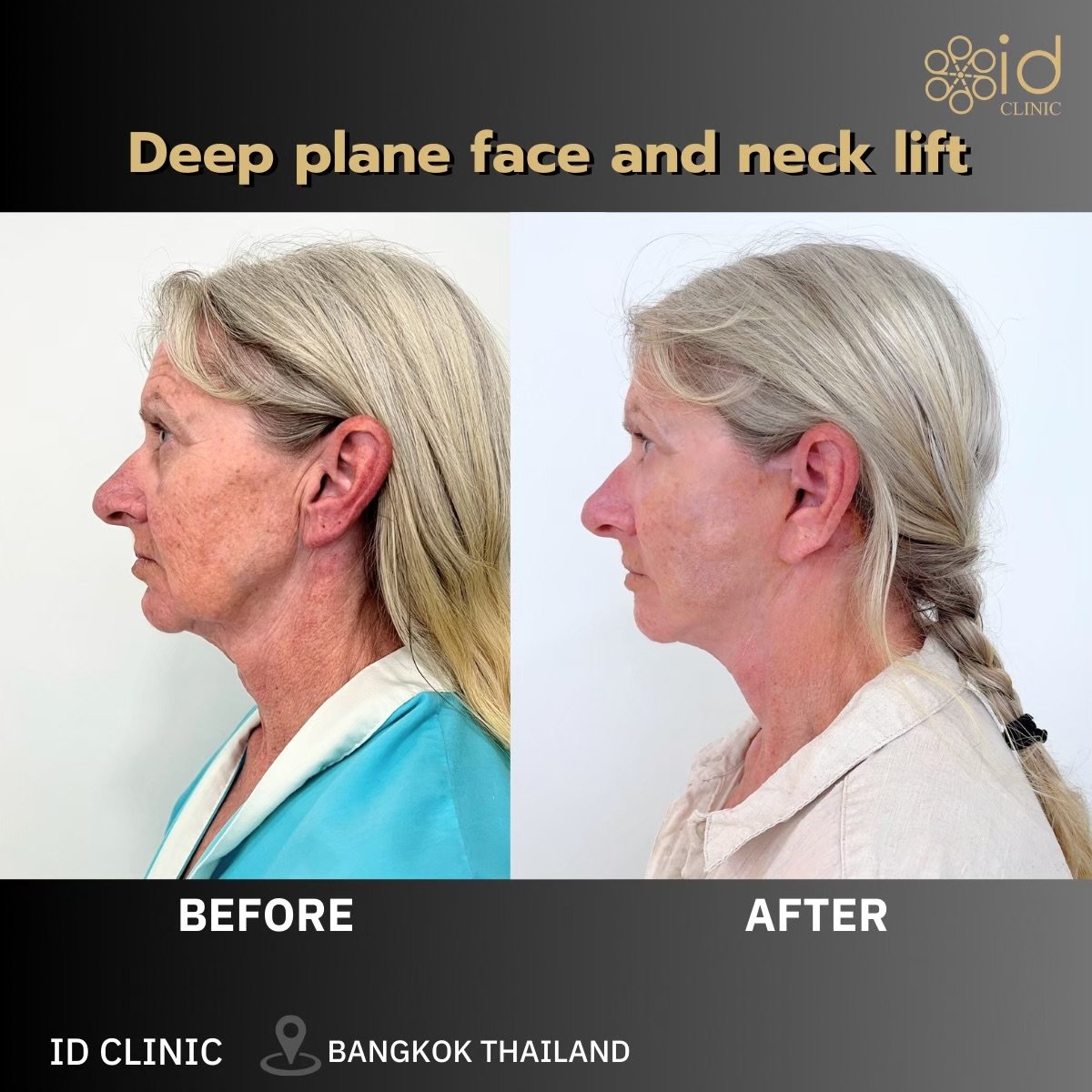 Before and after deep plane face and neck lift results at ID Clinic Bangkok, visible rejuvenation