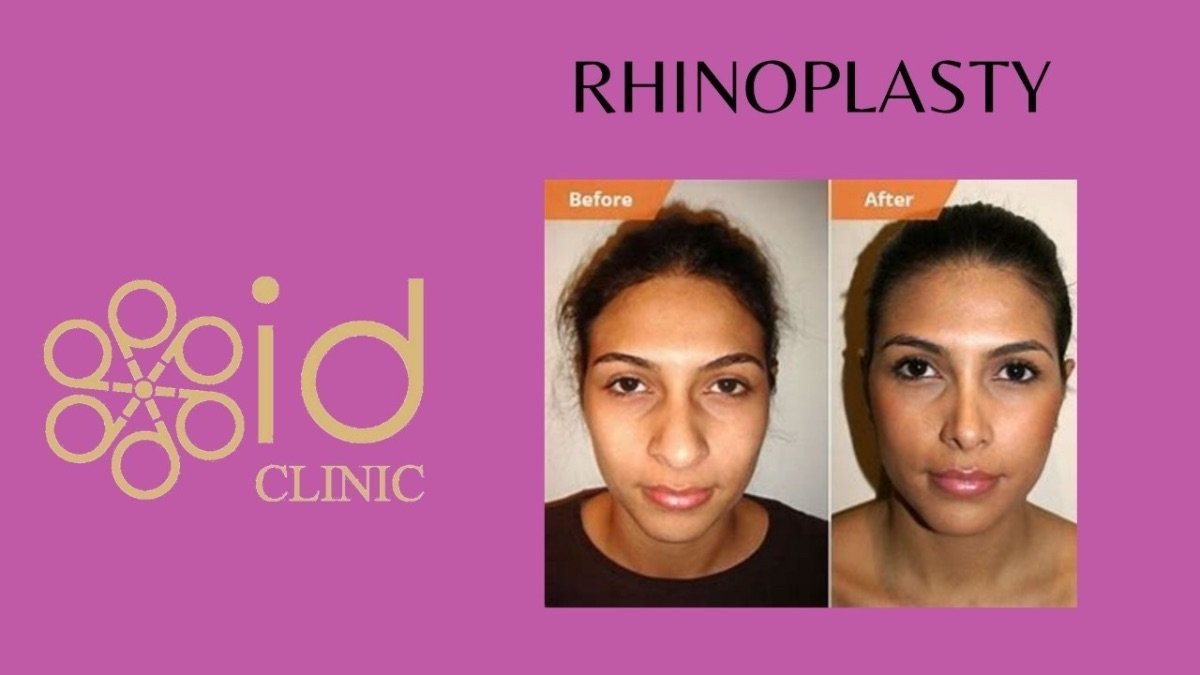 Before and after rhinoplasty results at ID Clinic Bangkok, nose reshaping with natural look