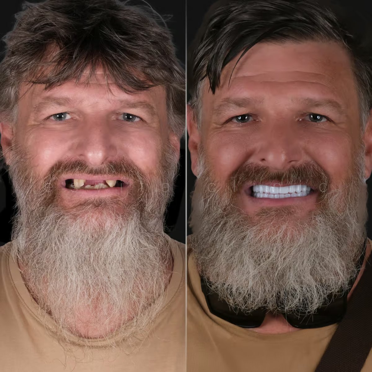 Before and after All-on-4 dental implants result at Esvita Clinic – restored full smile