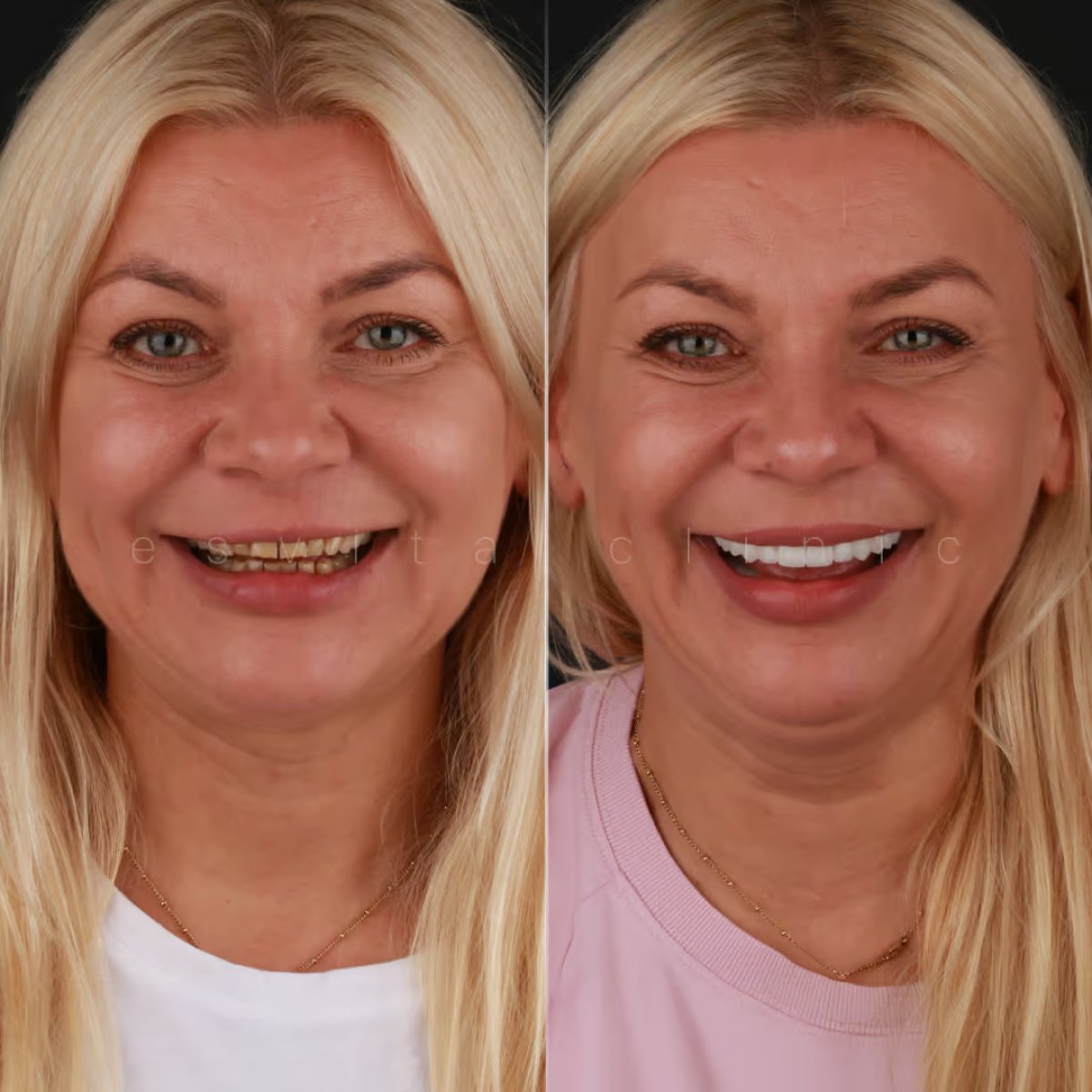 Before and after Hollywood Smile results at Esvita Clinic – dental veneers smile transformation
