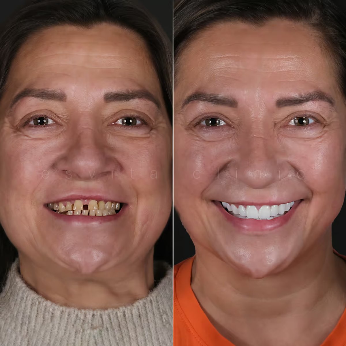 Resultados antes y después de Hollywood Smile en Esvita Clinic – transformación con carillas