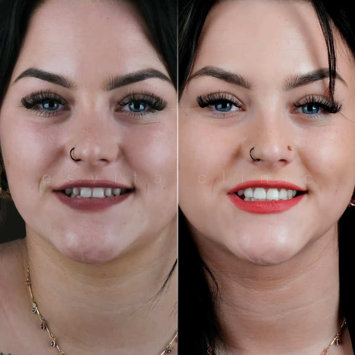 Before and after Hollywood Smile results at Esvita Clinic – enhanced white, even teeth