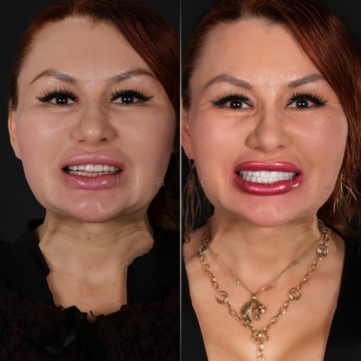 Before and after tooth whitening results at Esvita Clinic – visibly brighter smile transformation