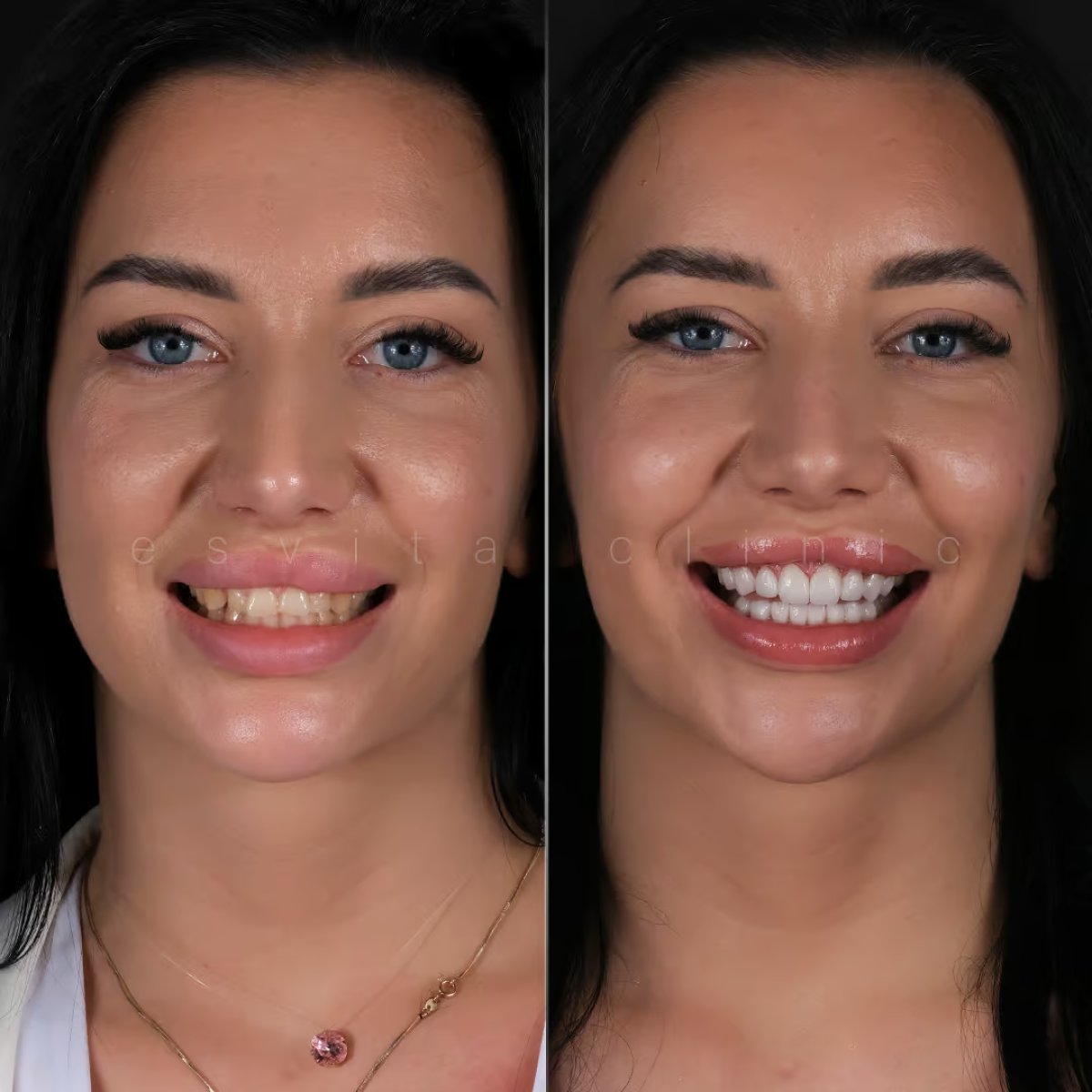 Before and after veneers at Esvita Clinic – smile transformation with natural-looking results