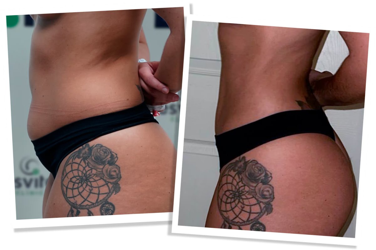Before and after liposuction results at Esvita Clinic – improved waist and body contour