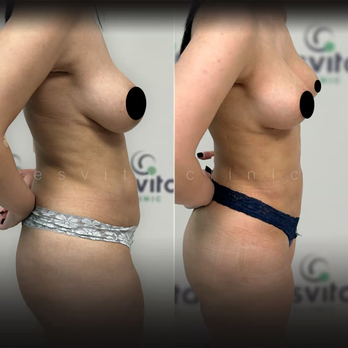 Before and after tummy tuck results at Esvita Clinic – improved abdominal contour