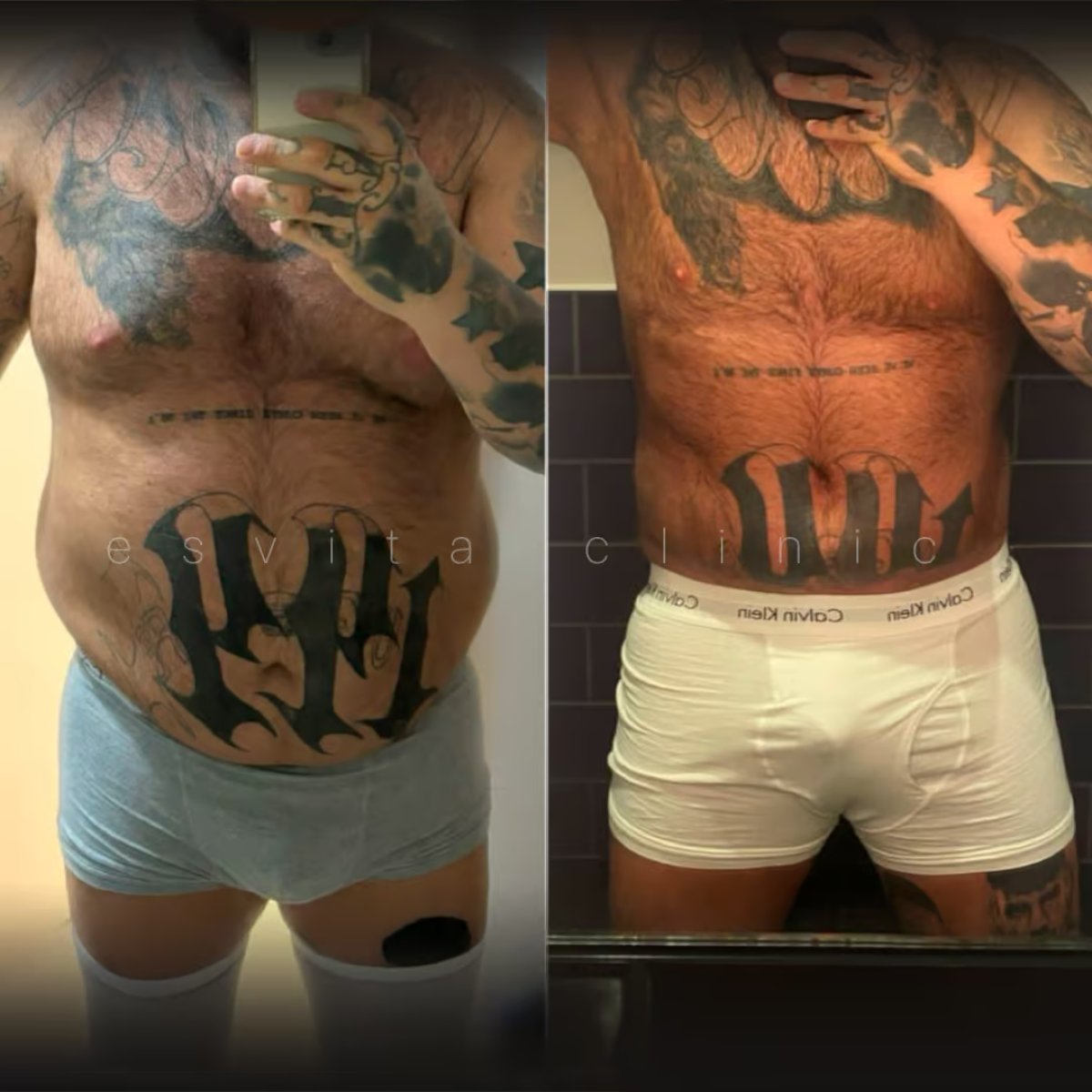 Before and after tummy tuck results at Esvita Clinic, visible abdominal contour improvement