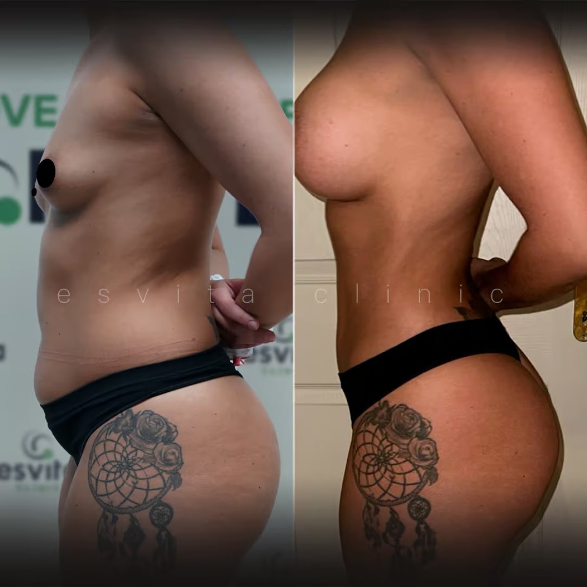 Avant et après augmentation mammaire à Esvita Clinic, forme et volume des seins améliorés